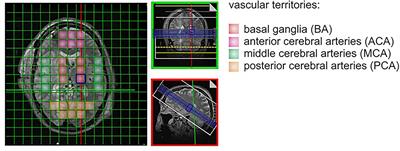 Cerebral Energy Status and Altered Metabolism in Early Brain Injury After Aneurysmal Subarachnoid Hemorrhage: A Prospective 31P-MRS Pilot Study